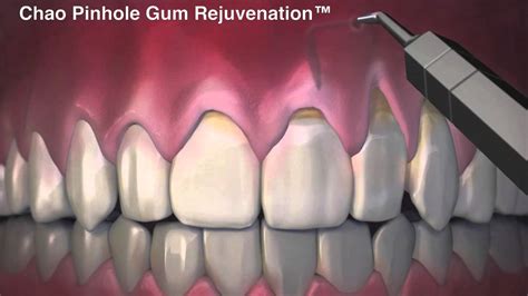 Pinhole Dental Surgical Procedure .